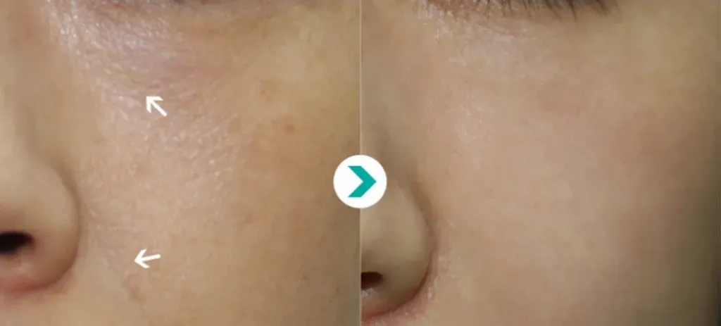 Revive Your Skin: The Benefits Of Skin Booster Injections