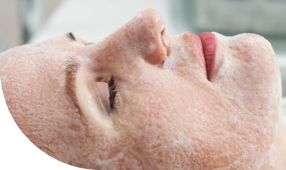 Frame-6585-1 Chemical Peels