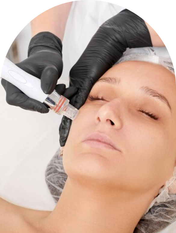 Frame-6585-2 RF Microneedling